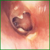 Chronic otitis media